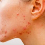 Foliculitis por gramnegativos