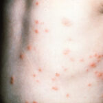 La foliculitis del jacuzzi (foliculitis por Pseudomonas)