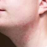 Foliculitis no bacteriana