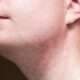 Foliculitis no bacteriana
