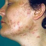 ¿Qué es la foliculitis eosinofílica?