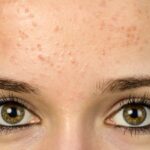 ¿Qué es la foliculitis por Pityrosporum?