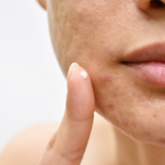 ¿Cuáles son los síntomas de foliculitis?