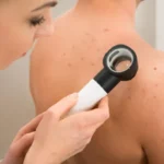Diagnóstico diferencial de la foliculitis