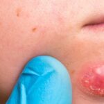 ¿Cuál es la principal complicación de la foliculitis?