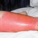 La celulitis es una infección común