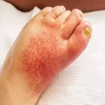 La erisipela es una infección cutánea aguda