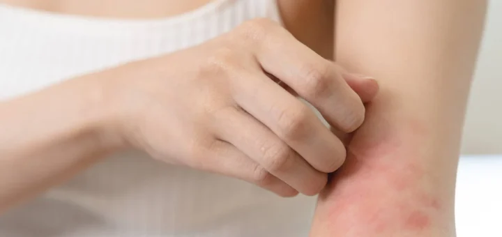 La Dermatitis Atópica es una inflamación crónica