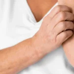 Medidas generales en el tratamiento de la dermatitis atópica