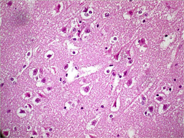 Morfología de la lesión neuronal aguda