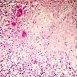 Morfología de la lesión neuronal subaguda y crónica