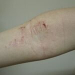 Complicaciones del tratamiento de la dermatitis atópica