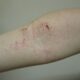 Complicaciones del tratamiento de la dermatitis atópica