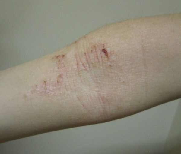 Complicaciones del tratamiento de la dermatitis atópica