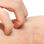 Tratamiento para la dermatitis atópica limitada