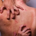 Tratamiento de la dermatitis atópica moderada a severa
