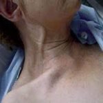Aumento de la presión yugular secundario a cor pulmonale