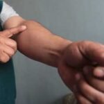 La hinchazón de un brazo puede deberse a trombosis