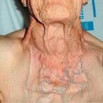 La congestión venosa de cabeza y el cuello puede deberse a un tumor