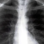 Pacientes con EPOC tienen datos de hiperinflación pulmonar