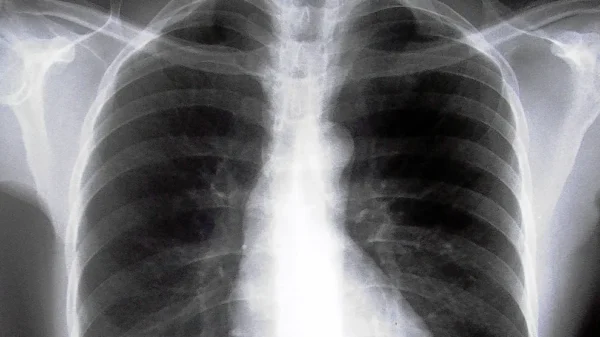 Pacientes con EPOC tienen datos de hiperinflación pulmonar