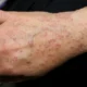 El liquen plano es una enfermedad inflamatoria pruriginosa