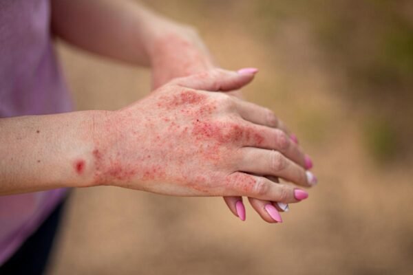 Lupus eritematoso cutáneo