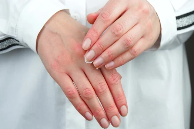 Dermatitis de contacto, tipo irritante o alérgica