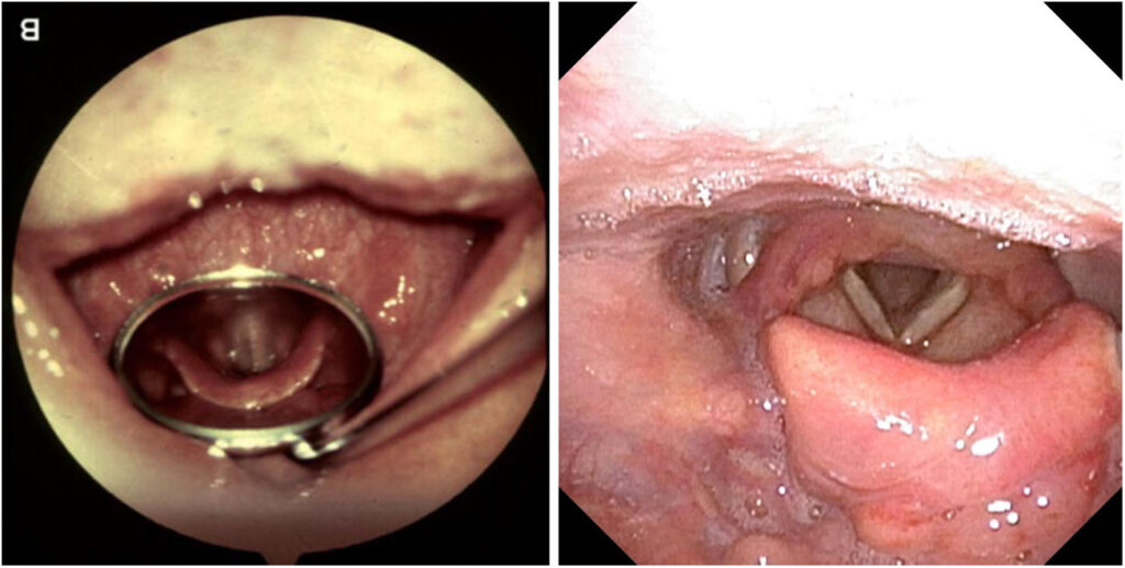 Epiglotitis