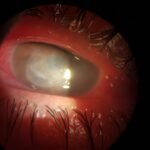 ¿Qué es la queratitis amebiana?