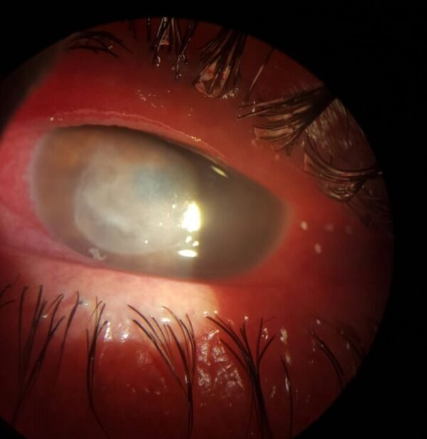 ¿Qué es la queratitis amebiana?