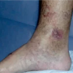 Úlceras por estasis venosa