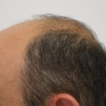 Alopecia