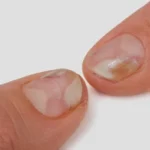 Trastornos de las uñas
