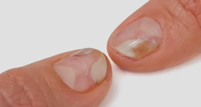 Trastornos de las uñas