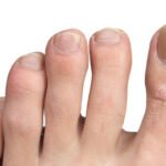 Onicomicosis