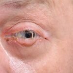 Conjuntivitis bacteriana