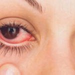 Enfermedad ocular alérgica