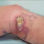 ¿Qué síndromes causan los protozoarios del género Leishmania?