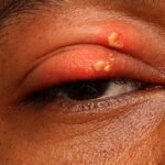 Herpes zóster oftálmico