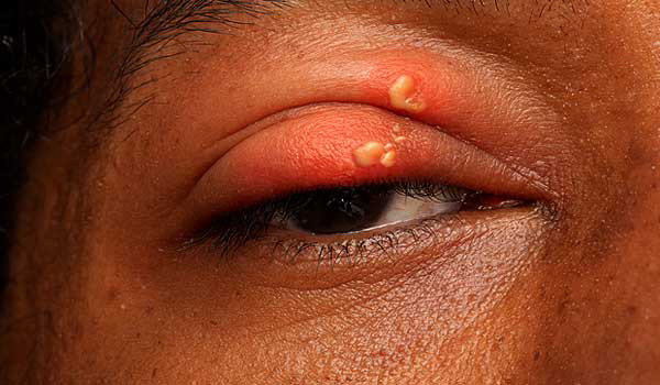 Herpes zóster oftálmico