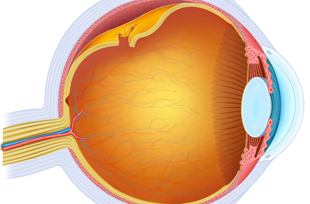 Desprendimiento de retina