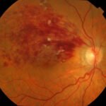 Oclusión de la vena retiniana central