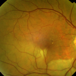 Oclusión de la arteria central de la retina