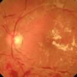 Retinopatía diabética