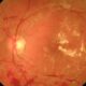 Retinopatía diabética