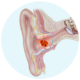 Impactación de cerumen