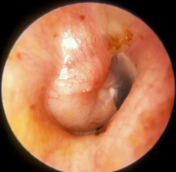 Tumores del oído medio