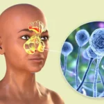 Sinusitis fúngica invasiva