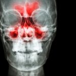 Enfermedad inflamatoria sinonasal